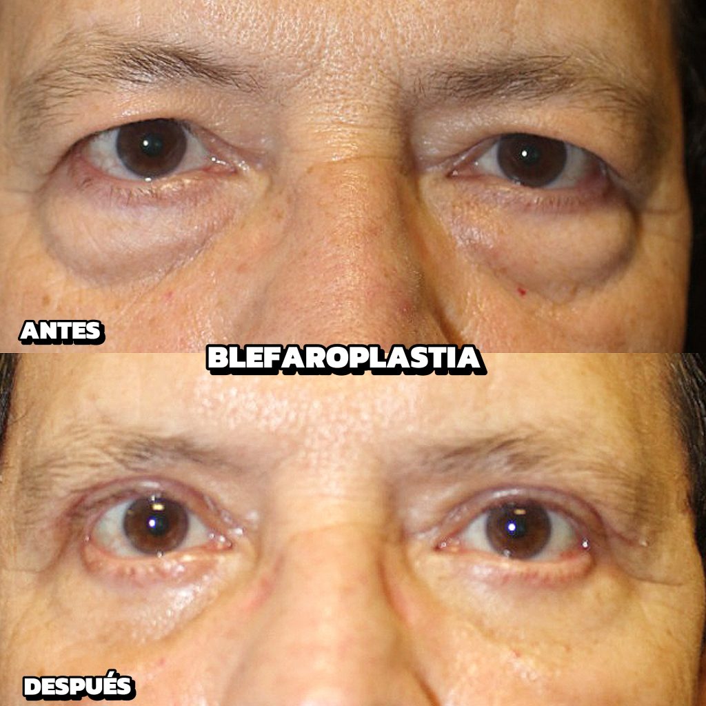 Blefaroplastia: el secreto para rejuvenecer tu mirada Blefaroplastia: el secreto para rejuvenecer tu mirada